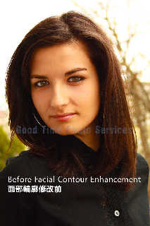 Enhance facial profile - Before