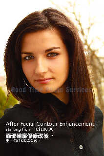 Enhance facial profile - After